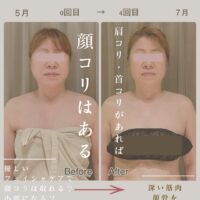 顔コリ